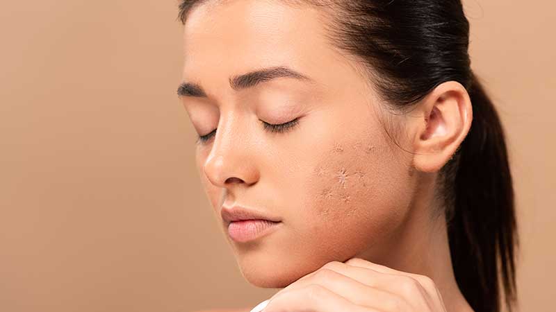 בחורה עם צלקות אקנה